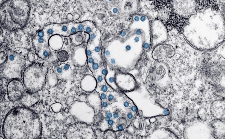 Transmission electron microscopic image of an isolate from the first U.S. case of COVID-19 The spherical viral particles, colorized blue, contain cross-section through the viral genome, seen as black dots. (Centers for Disease Control and Prevention)